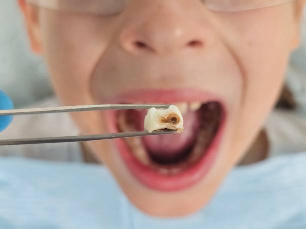 Best Emergency Dental Extractions in Beach, ND